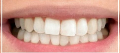 After treatment - white teeth