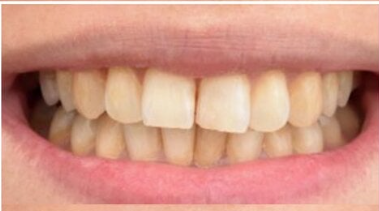 Before treatment - stained teeth