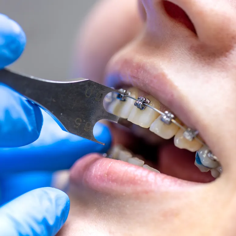 Braces Treatment