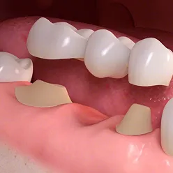 Dental Bridges