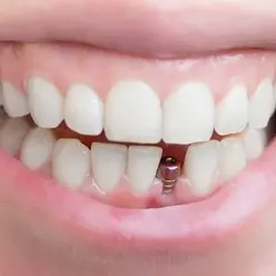 Dental Implant