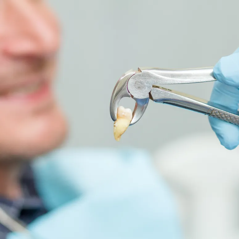 Tooth Extractions