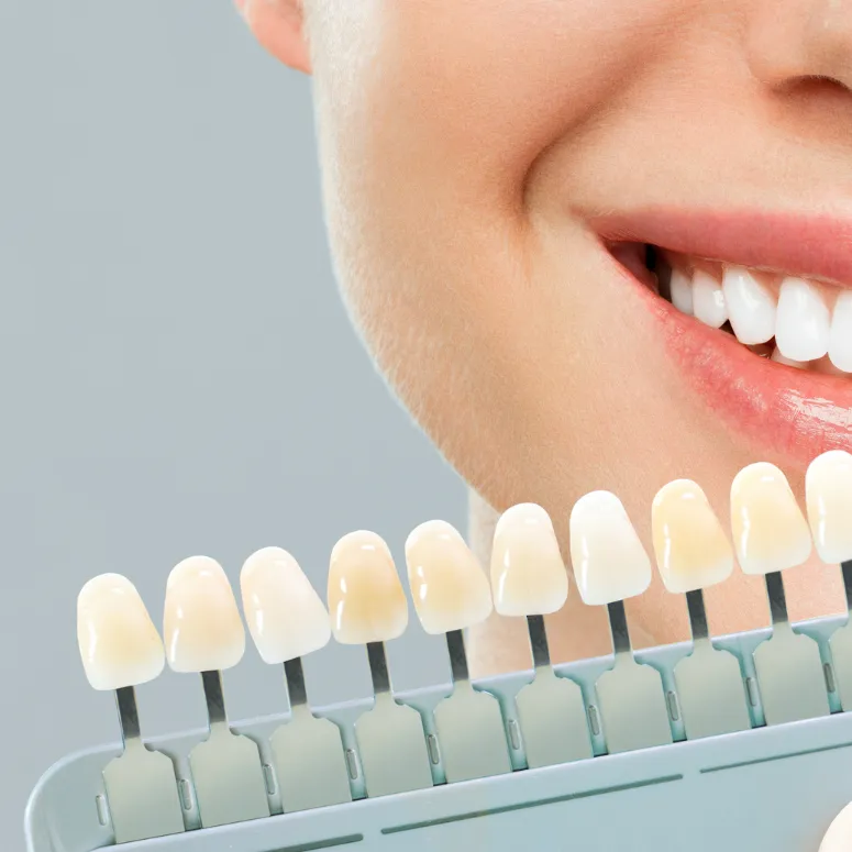 Veneers